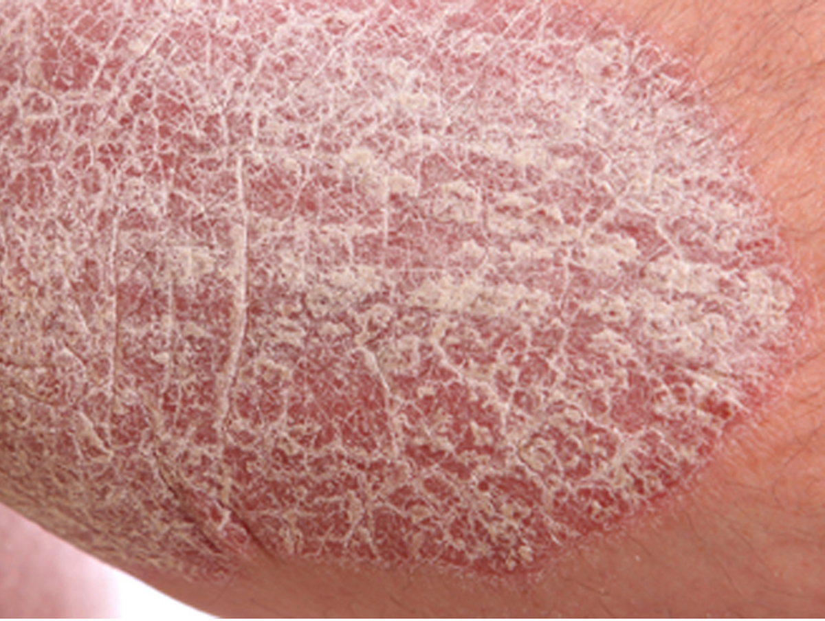 Psoriasis and Homoeopathy