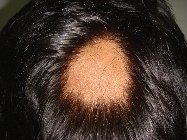 Alopecia Areata