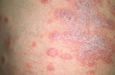 Lichen Planus