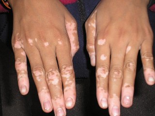 Vitiligo Treatment